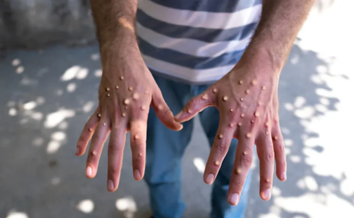 Cases of monkeypox