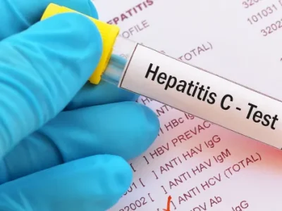Hepatitis C virus (HCV) test.jpg